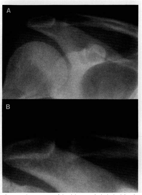 Figure 1 From Osteolysis Of The Distal Clavicle In A Female Body