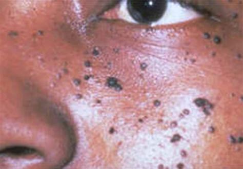 Dpn Dermatosis Papulosa Nigra Deepa Skin Care
