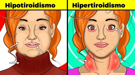Síntomas de tiroides en mujeres hipotiroidismo e hipertiroidismo signos causas y tratamiento