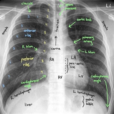 How To Interpret A Chest X Ray Dreamqo