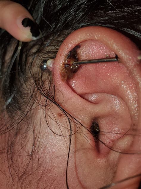 Infected Industrial Should I Remove R Piercing