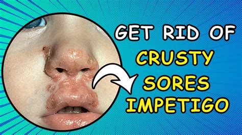 Bullous Impetigo Skin Infection Crusty Sores Causes Symptoms