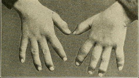 Six Causes Of Dactylitis Sausage Fingers