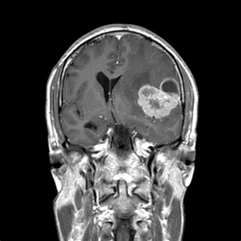 Mri Scan Nhs Mri Scan Brain Scan Mri Brain Images