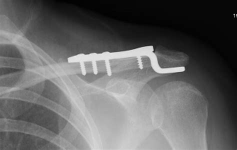 Clavicle Fractures The Shoulder And Elbow Clinic