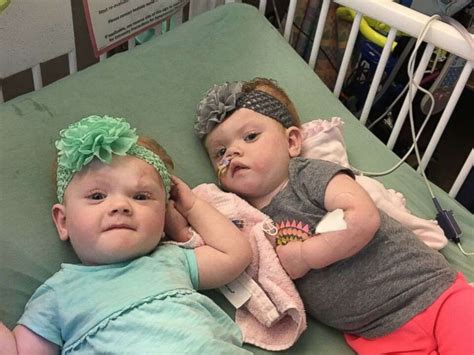 Formerly Conjoined Twins Sent Home 5 Months After Separation Abc News