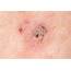 Melanoma Skin Cancer On The Arm  Stock Image C009/0096 Science