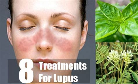 8 Treatments For Lupus Lupus