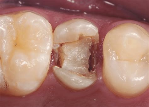 The Old Composite Resin Restoration Was Dislodged During The Clinical