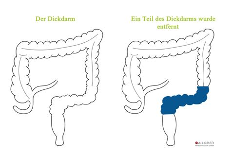 Dünnflüssiger stuhl (masculine noun) liquid stool: Gut Essen, gut Leben - Kolostomie - Produktinformationen