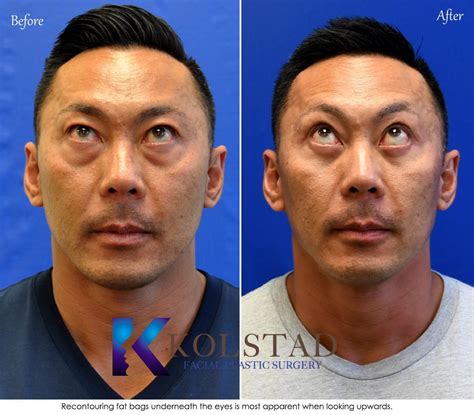 Before And After Plastic Surgery Asian