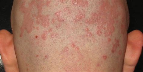 Dermatite Seborroica Cuoio Capelluto Cause E Rimedi Naturali Hot Sex