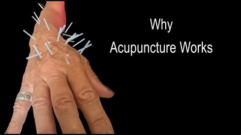 Why Acupuncture Works Youtube