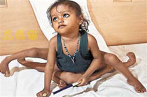 Индийские хирурги оперируют девочку с восемью конечностями новости