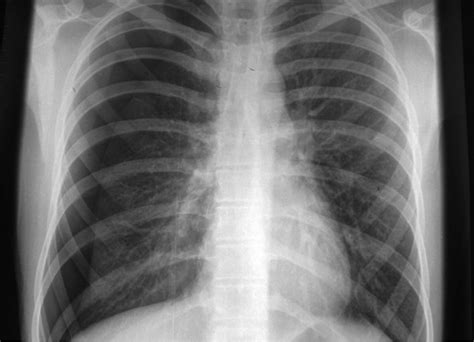 Your facebook albums, disk (computer) or take. PEM Blog - Chest X-Ray Challenge!