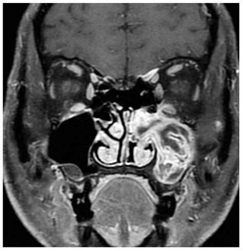 Inverted Papilloma Nose Hot Sex Picture