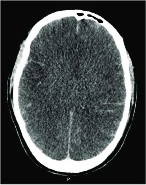 Computed Tomography Of The Brain Showing Subarachnoid Hemorrhage Noted