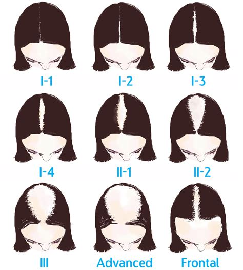Any factors that influence the natural hair cycle will ultimately determine how many hairs you are losing per day. Michelle Obama's 'Bald' TV Appearance Causes Concern
