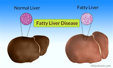 Fatty Liver Disease Fld Causes Symptoms Treatment Prevention