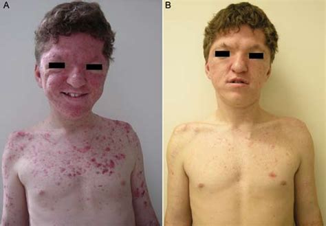 Figure 1 From Successful Isotretinoin Treatment Of Acne In A Patient