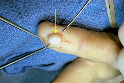 Epidermoid Cyst Hand Surgery Source