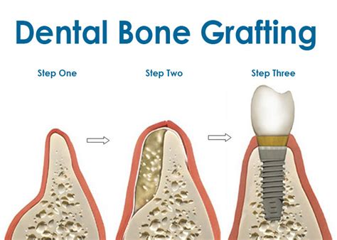 Bone Graft For Tooth Implant In Lewisville Tx Dental Extraction