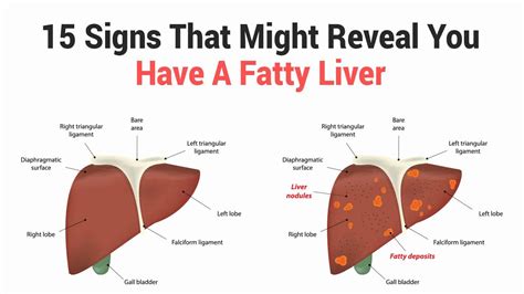 15 Signs That Might Reveal You Have A Fatty Liver 6 Minute Read In