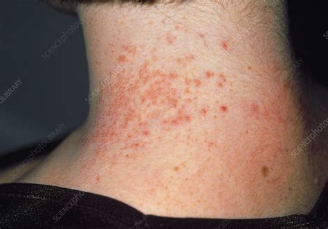 Contact Dermatitis Caused By Necklace Stock Image M3200245