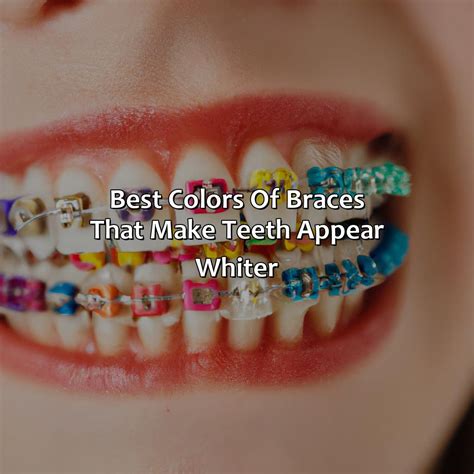 What Color Braces Make Your Teeth Look Whiter