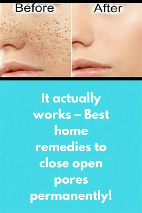 It Actually Works Best Home Remedies To Close Open Pores Permanently