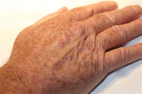 Skin Lesions On Hands Printable Templates Protal