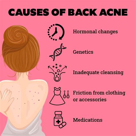 Best Ways To Get Rid Of Back Acne
