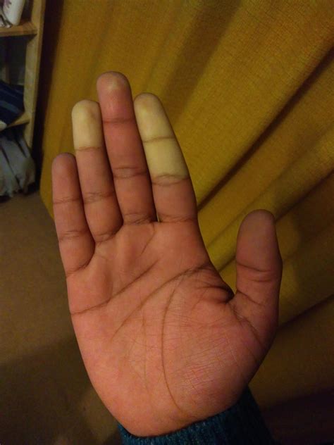 My Fingers Turn White When Its Cold Fingers Turn White Turn Ons Finger