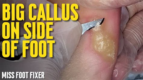 Treatment Of Big Callus On Side Of Foot 2022 Full Video By Miss Foot