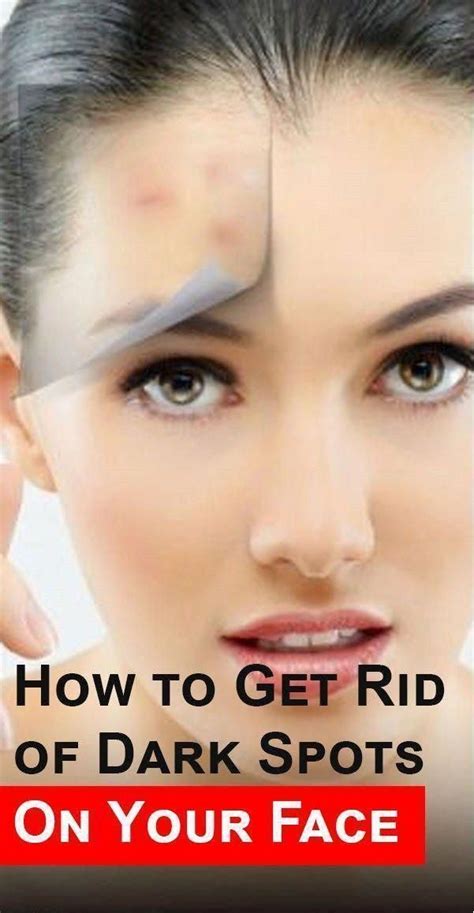 How To Get Rid Of Brown Spots On Encounter Whitedeerwithbrownspots