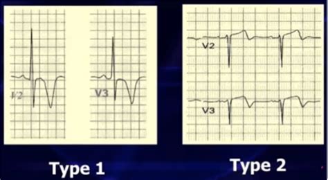 Wellens Syndrome Ecg Weekly