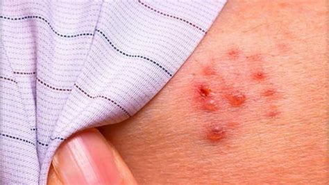 signs and symptoms of shingles entirely health