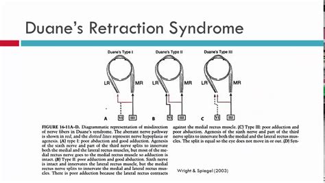 Duane Retraction Syndrome Types