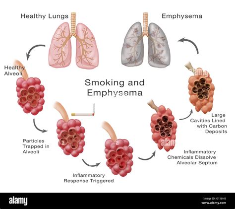 Stages Of Lung Damage Of A Smoker Leading To Emphysema The