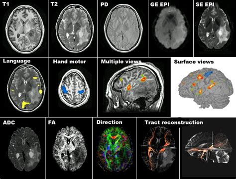 Mri And Medical Imaging Mri And Neurodegenerative Diseases