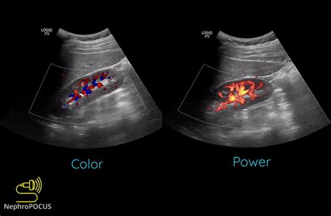 Basics Of Doppler Ultrasound For The Nephrologist Part 1 Renal