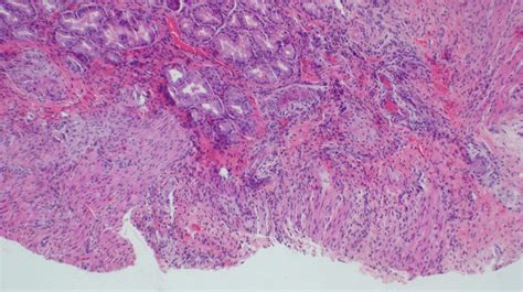 Histological Appearance Of Gastric Wall Showing Ulceration Mild Download Scientific Diagram