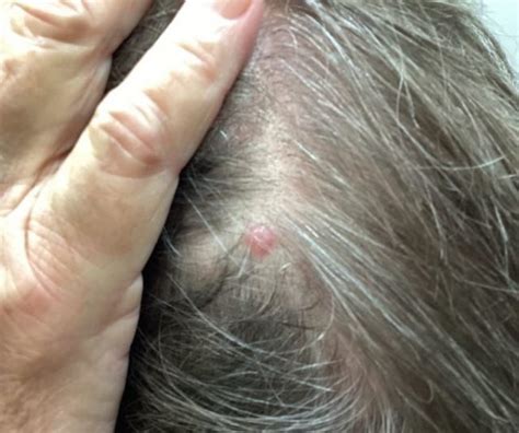Dermdx Solitary Hairless Lesion On Scalp Clinical Advisor
