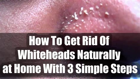 How To Get Rid Of Whiteheads Naturally Whiteheads Remedy Whiteheads