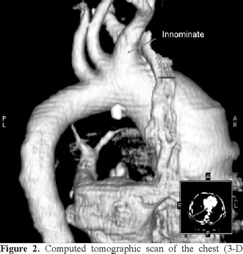 Figure 2 From Unicuspid Aortic Valve And Aortic Arch Aneurysm In A