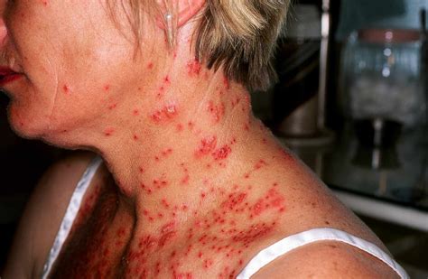 Eczema Atopic Dermatitis Overview And More