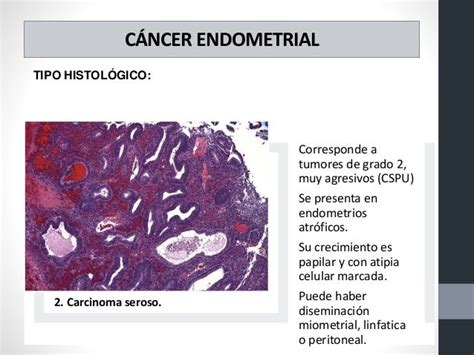 Cancer Cervico Uterino
