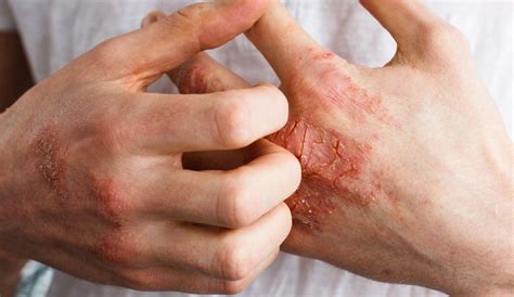 Dermatite At Pica O Que Sintomas Causas E Tratamento Df Expresso Hot