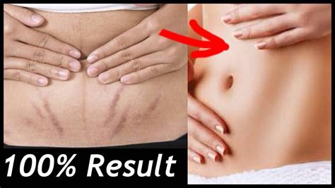 In 5 Days Remove Stretch Marks Completely II World S Best Remedy For