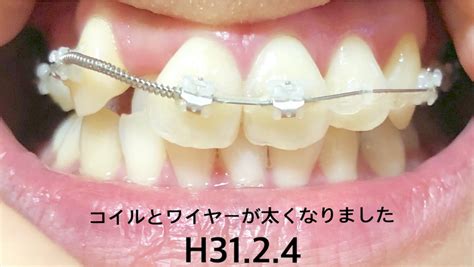 木下矯正歯科 mikio kinoshita orthodontic office. 大人の歯列矯正 12 〜 前歯の経過報告 〜 - 大人の歯列矯正 ♫ ...